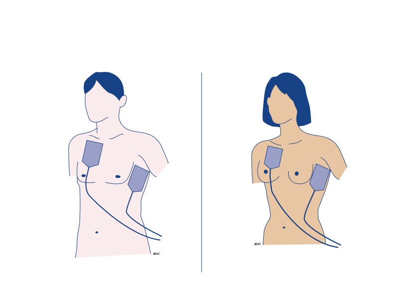 correct defib pad placement demonstrated on male and female body